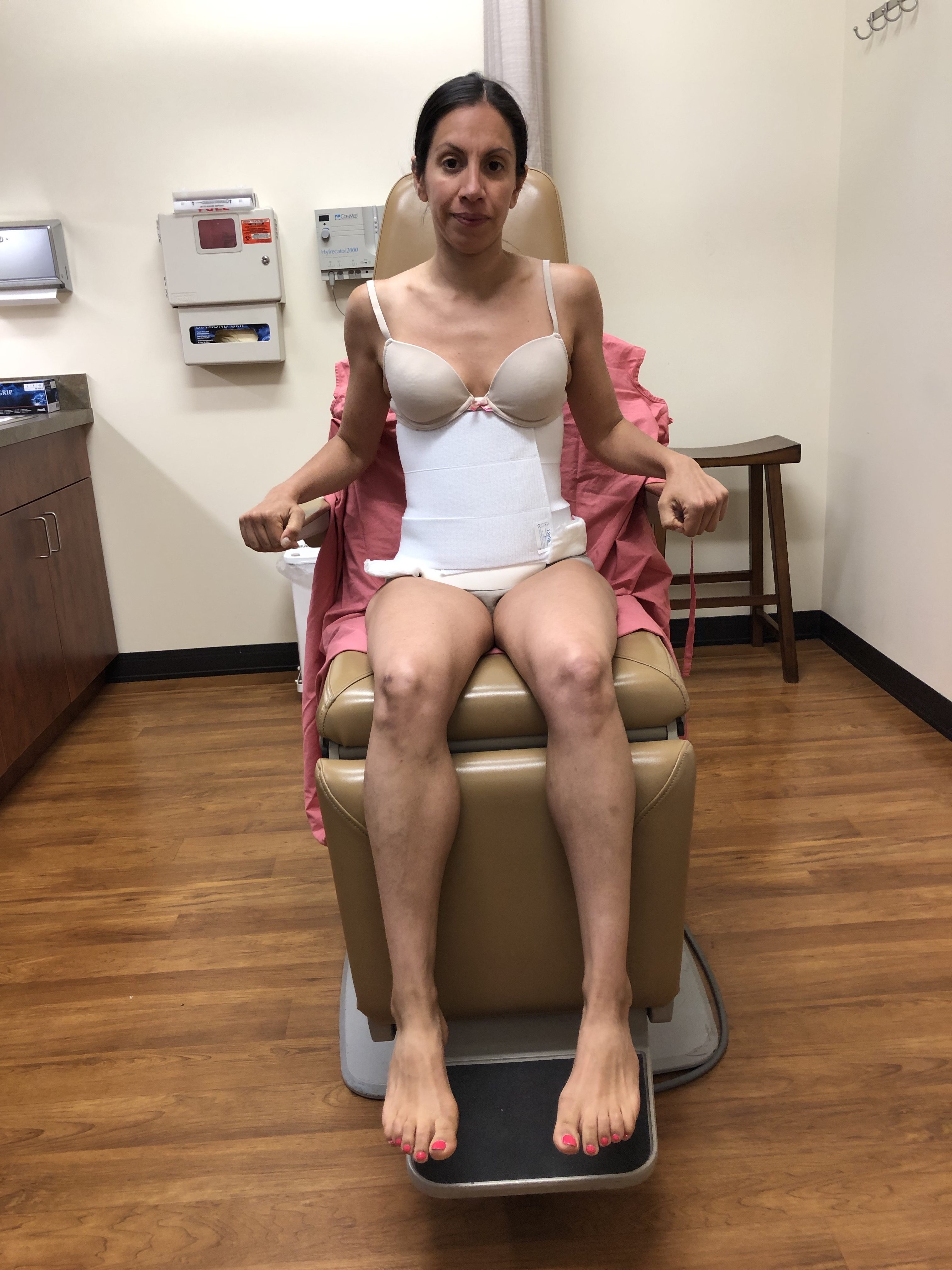 Sitting in chair the morning after my tummy tuck surgery with my surgical  drains and compression garment - Tummy Tuck for Men - Tummy Tuck For Men /  Male Tummy Tuck